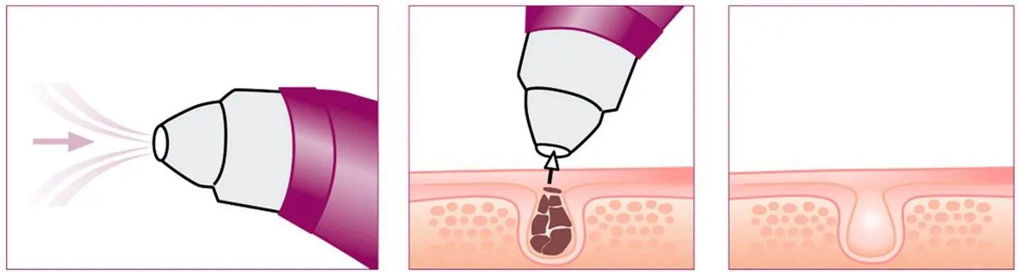 Очиститель пор Beurer FC 41 (White/Purple)