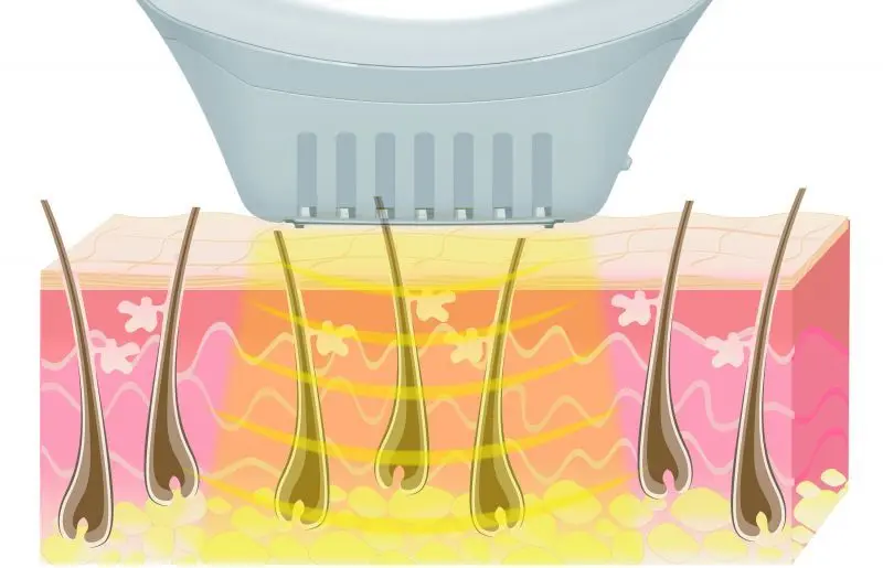 Epilator Beurer IPL10000+ SalonPro System (White/Brown)